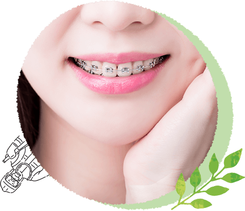 4.矯正歯科治療中のむし歯予防